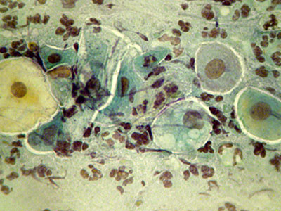 atrophisches Zellbild